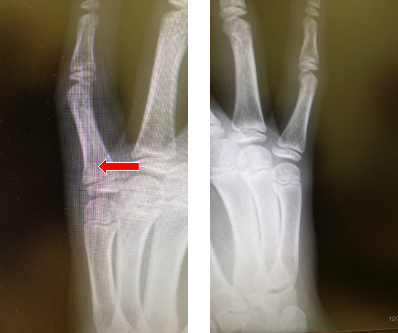 左手正斜位 左中指远节指骨骨折 对位对线差经过21天的固定昨天复查后说远断端向背侧移位怎么办_百度知道
